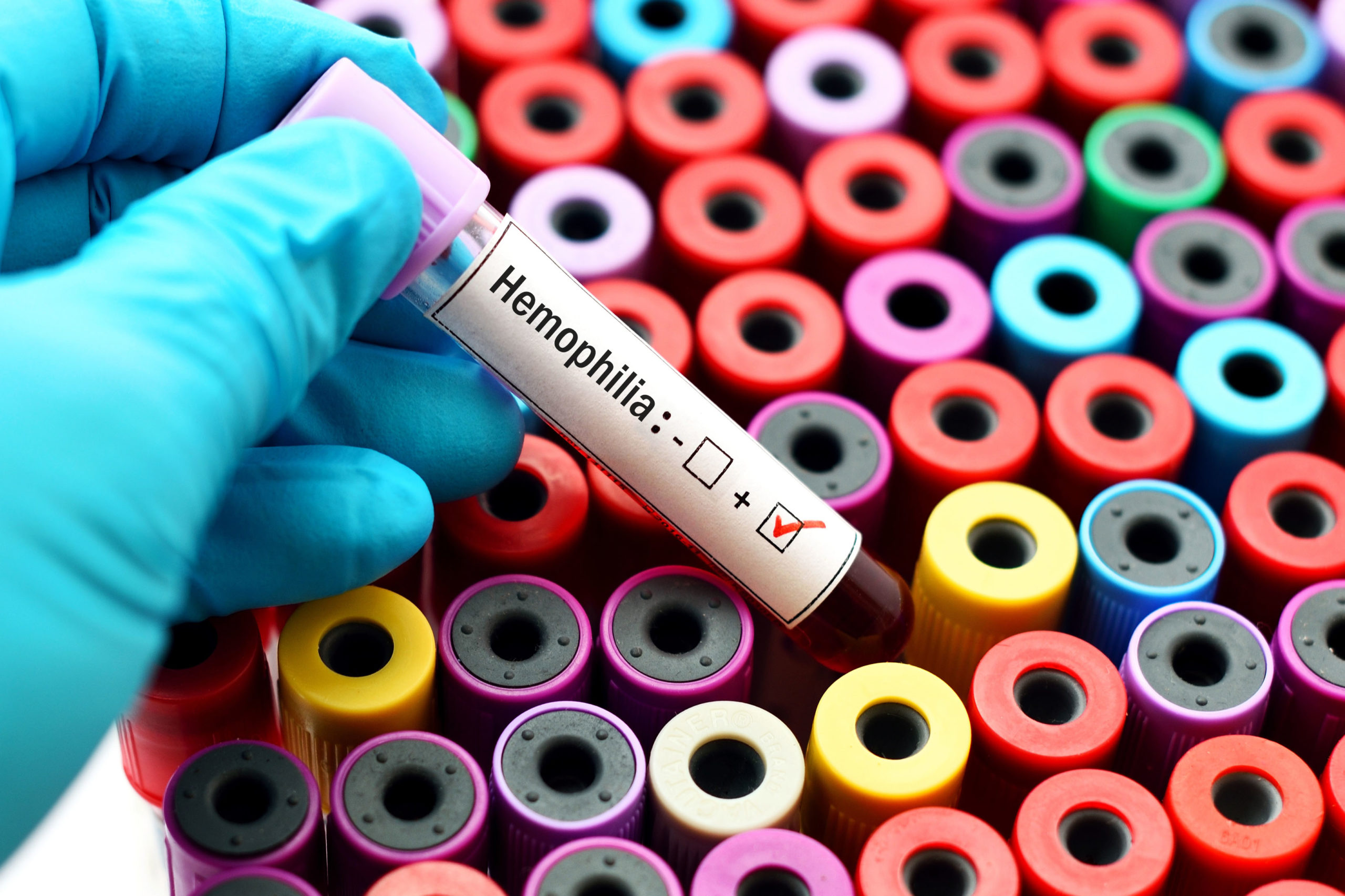 Malaysia to host 2024 Hemophilia World Congress